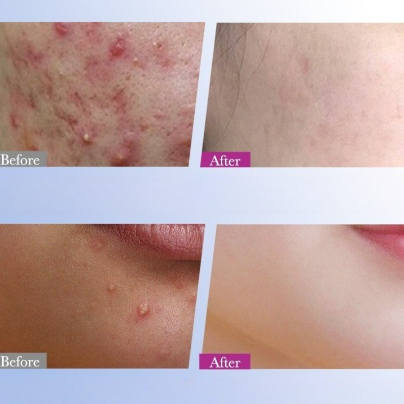 Patch d'acné étoile coloré, 7/ - Skincare Qv avis et prix